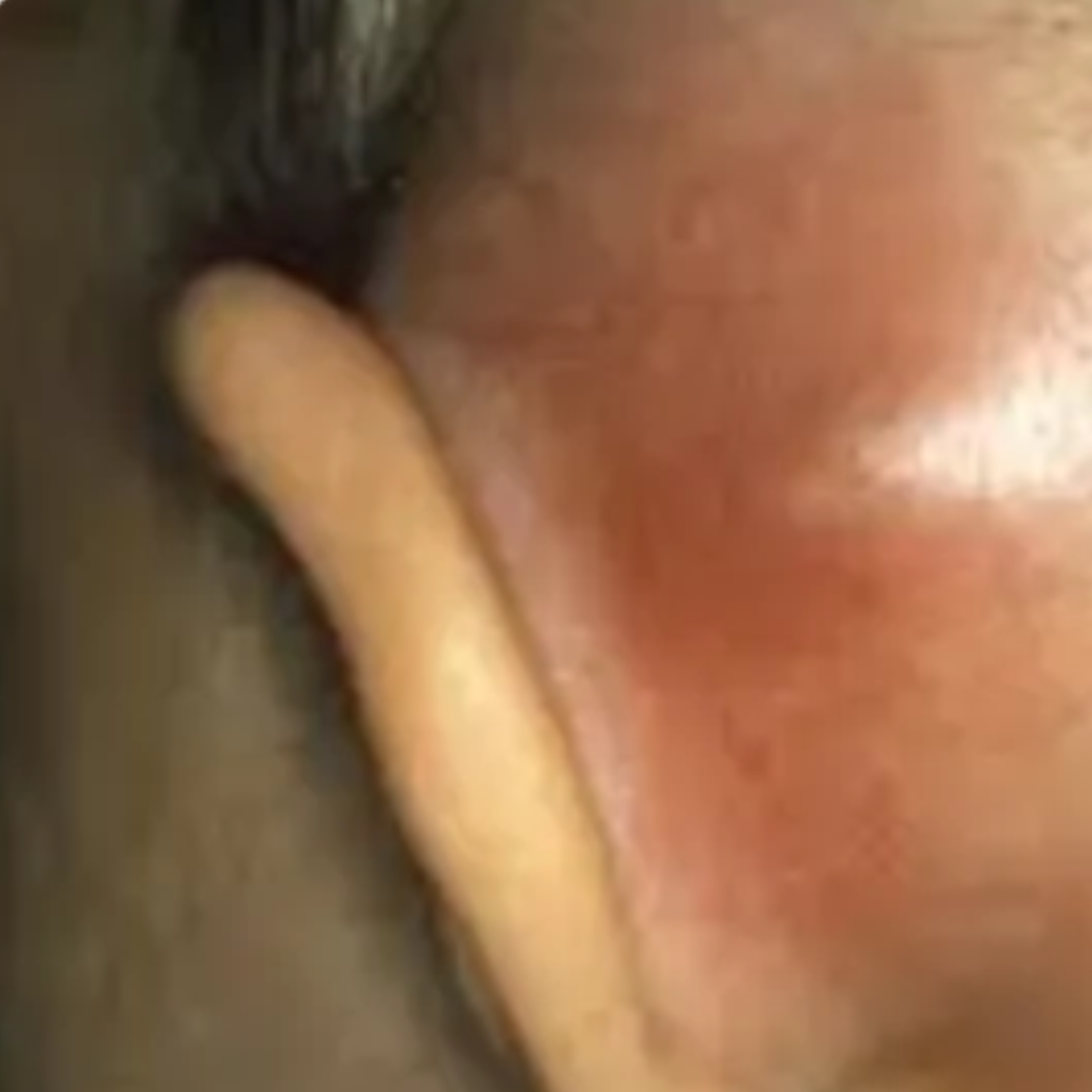 Mastoiditis