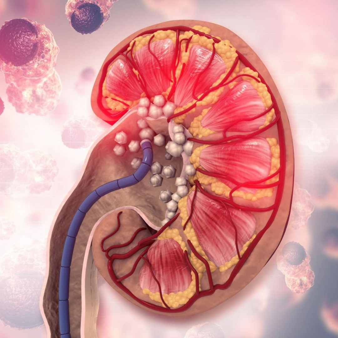 Stones causing obstruction and repeated infections