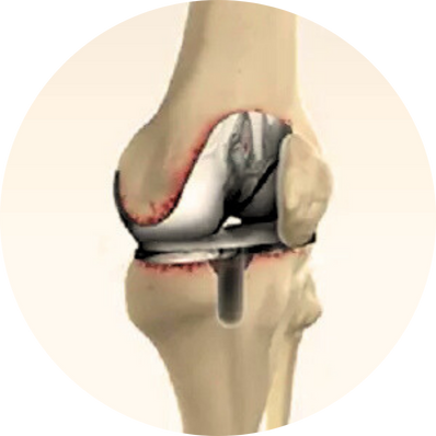 Revision Joint Replacement