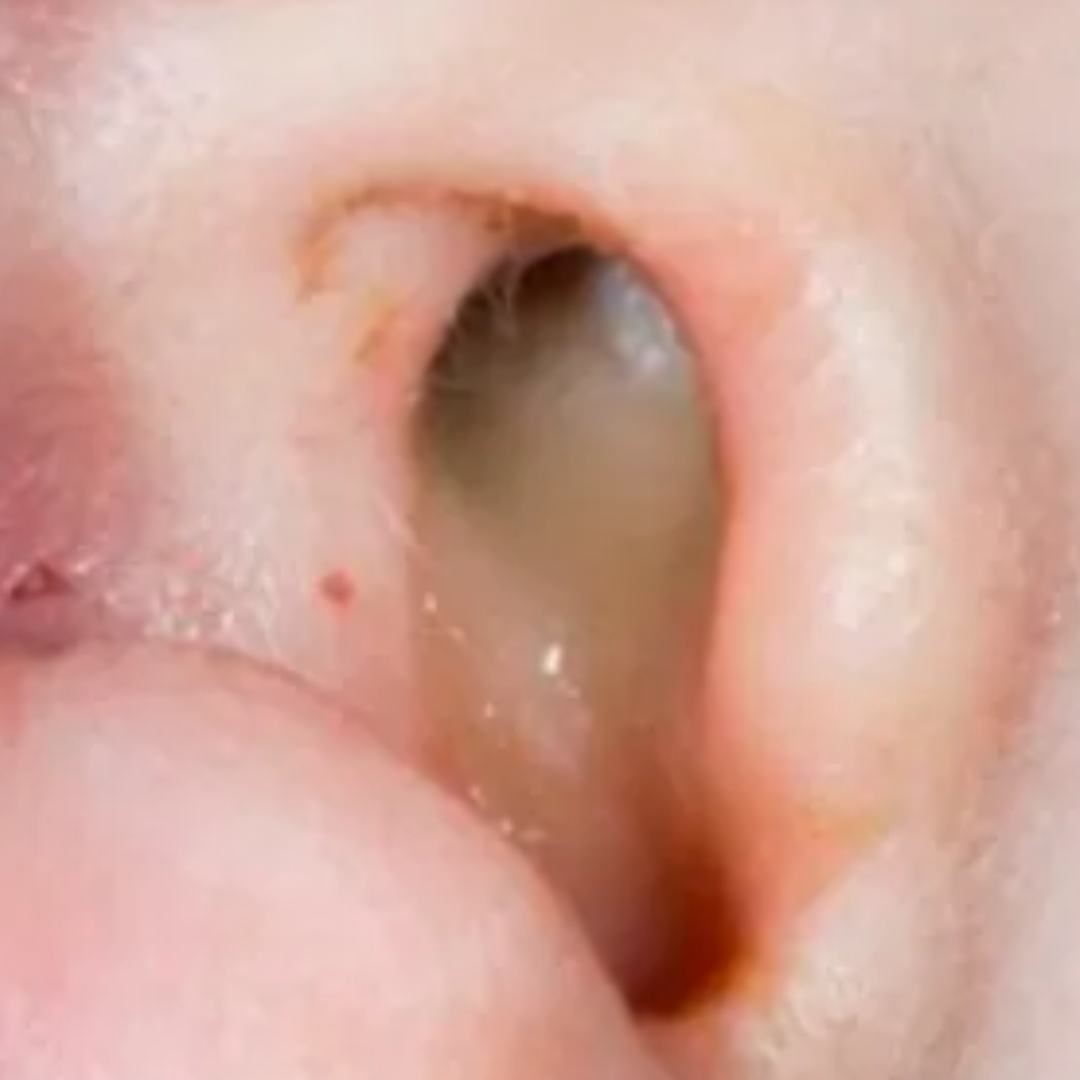 Cholesteatoma