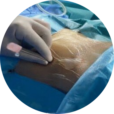 Ultra-mini PCNL