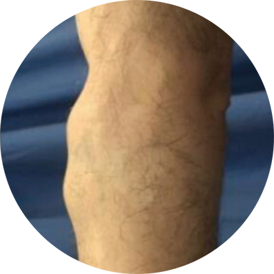 Angiolipoma