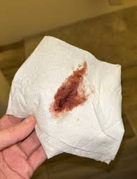 Vaginal spotting or dark brown bleeding