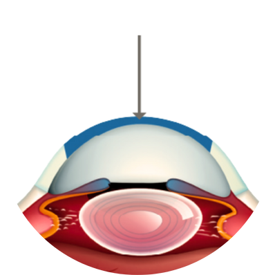 Penetrating Keratoplasty (PKP)