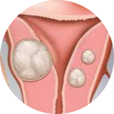Radical hysterectomy