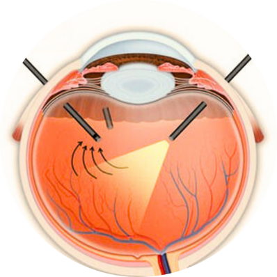 Pars plana vitrectomy (PPV)