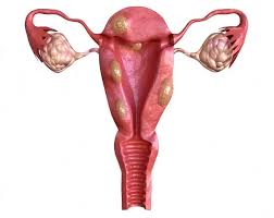 Ovarian cysts