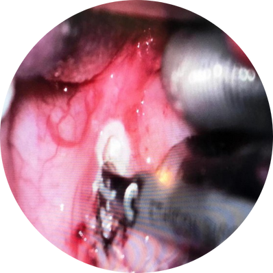 Harmonic scalpel tonsillectomy
