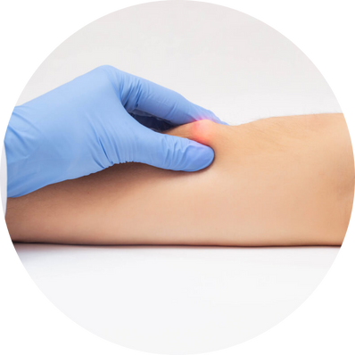 Conventional Lipoma