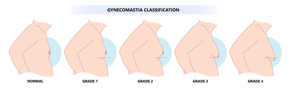 Gynecomastia Classification (Grades 1–4)