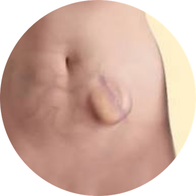 Incisional Hernia
