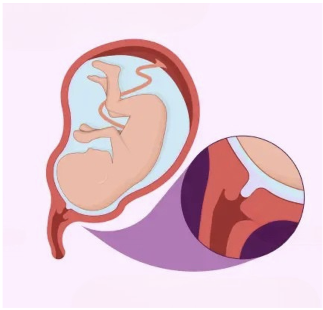 Dilatation and effacement of the cervix