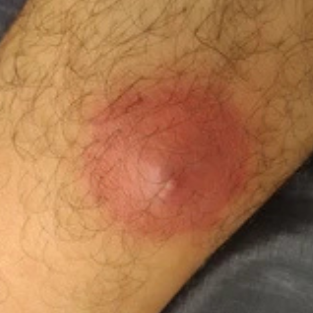 Pain or discomfort due to pressure on nerves or tissues