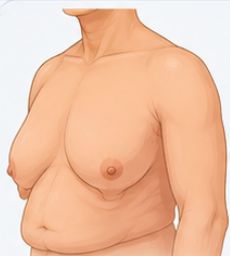 Severe Gynecomastia