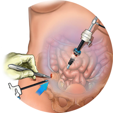 Diagnostic laparoscopy